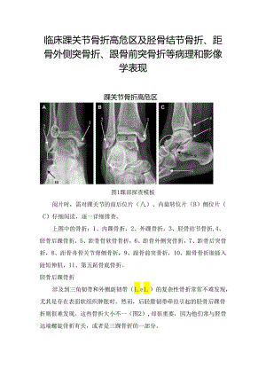 临床踝关节骨折高危区及胫骨结节骨折、距骨外侧突骨折、跟骨前突骨折等病理和影像学表现.docx