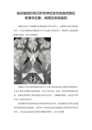 临床脑组织铁沉积性神经变性疾病虎眼征影像学征象、病理及疾病鉴别 - 副本.docx