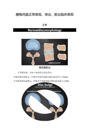 腰椎间盘正常表现、突出、膨出临床表现.docx
