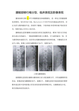 腰骶部移行椎分型、临床表现及影像表现.docx
