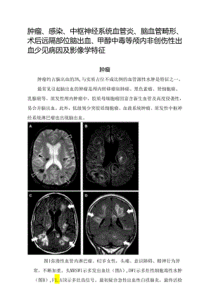 肿瘤、感染、中枢神经系统血管炎、脑血管畸形、术后远隔部位脑出血、甲醇中毒等颅内非创伤性出血少见病因及影像学特征.docx