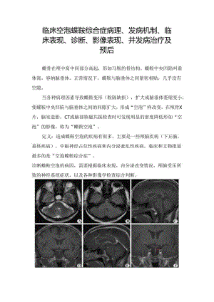临床空泡蝶鞍综合症病理、发病机制、临床表现、诊断、影像表现、并发病治疗及预后.docx