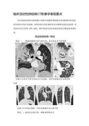 临床活动性肺结核CT影像学表现要点.docx